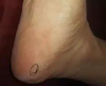 一病一绝招,治疗一病一穴奇效法