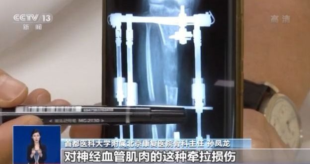 直腿神器,直腿神器有用吗