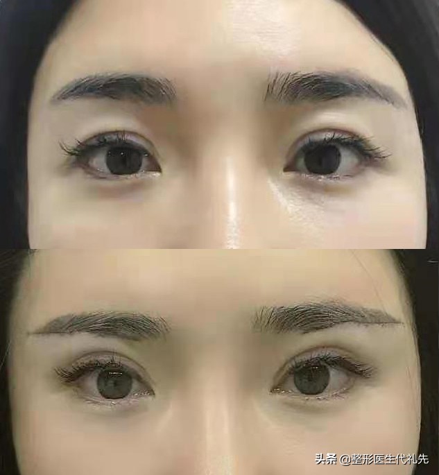 50岁做提眉眼袋手术能保持多久,提眉去眼袋手术15天图片