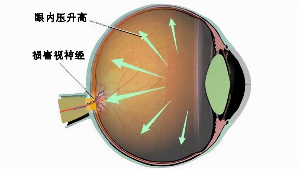 人的眼球脆弱吗,人的眼球破了会怎么样