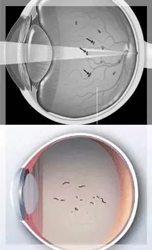眼前一直有蚊子是什么病,眼前总有蚊子飞怎么治呀