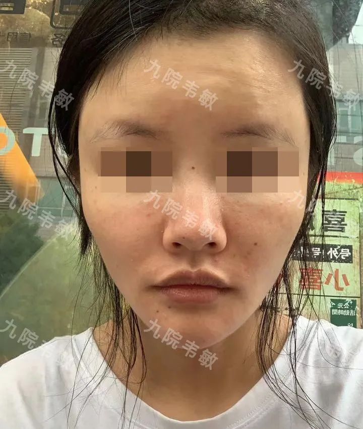 我终于摆脱了扁塌鼻这个颜值“拖油瓶”
