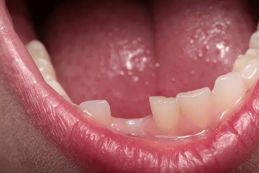 为什么牙齿矫正医生建议拔牙,牙齿矫正医生说要拔牙有的说不拔