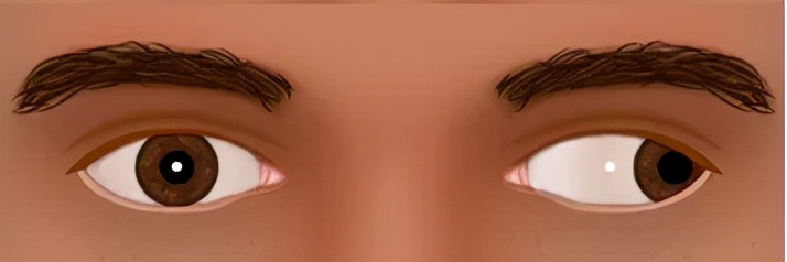 怎么判断间歇性外斜视,间歇性外斜视怎么算是严重