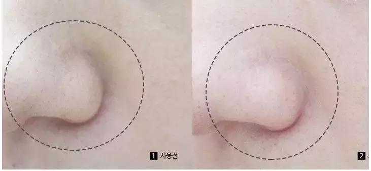 吸黑头神器去粉刺角质收缩毛孔,皮肤清洁收缩毛孔黑头角质