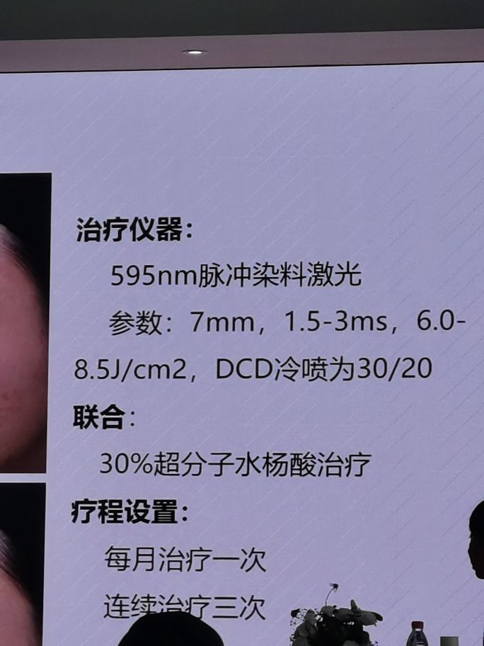 脉冲染料激光治玫瑰痤疮怎么收费,脉冲染料激光治疗瘢痕疙瘩