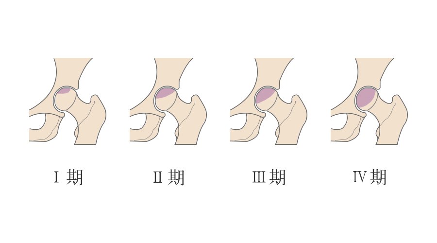 发现股骨头坏死一期到四期多久,发现右腿股骨头坏死2期