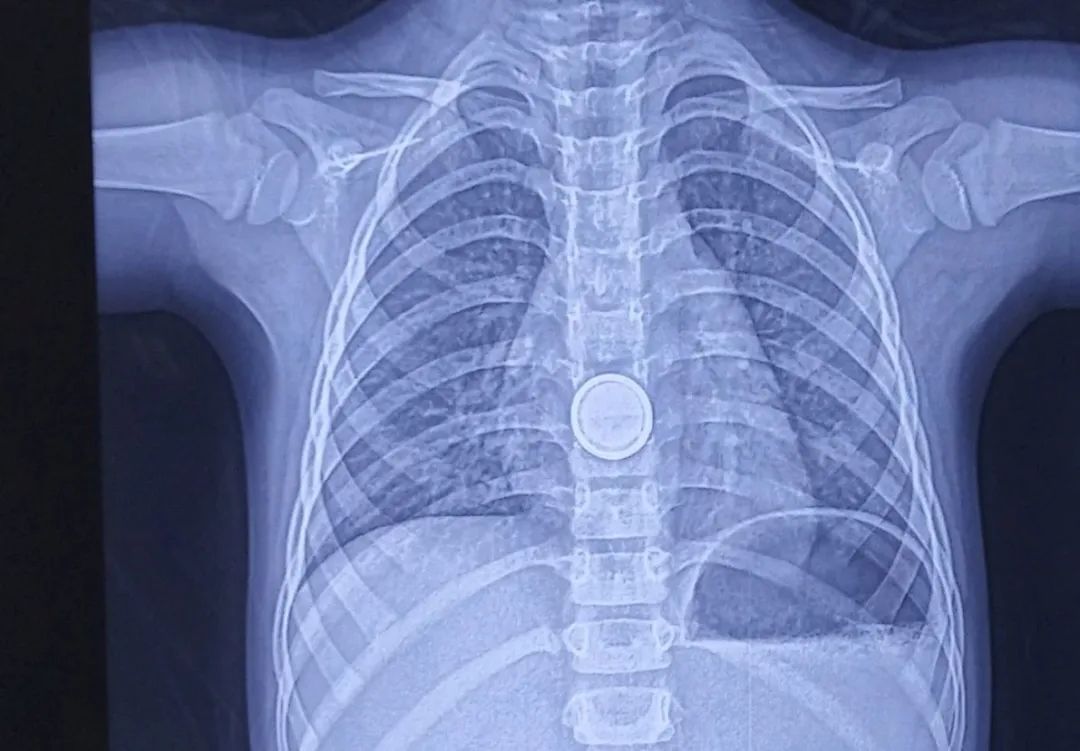 3岁女孩误吞12粒磁力珠,女童吞61颗磁力珠