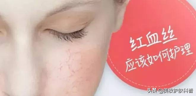 皮肤有血丝有点红怎么修复,红血丝养肤