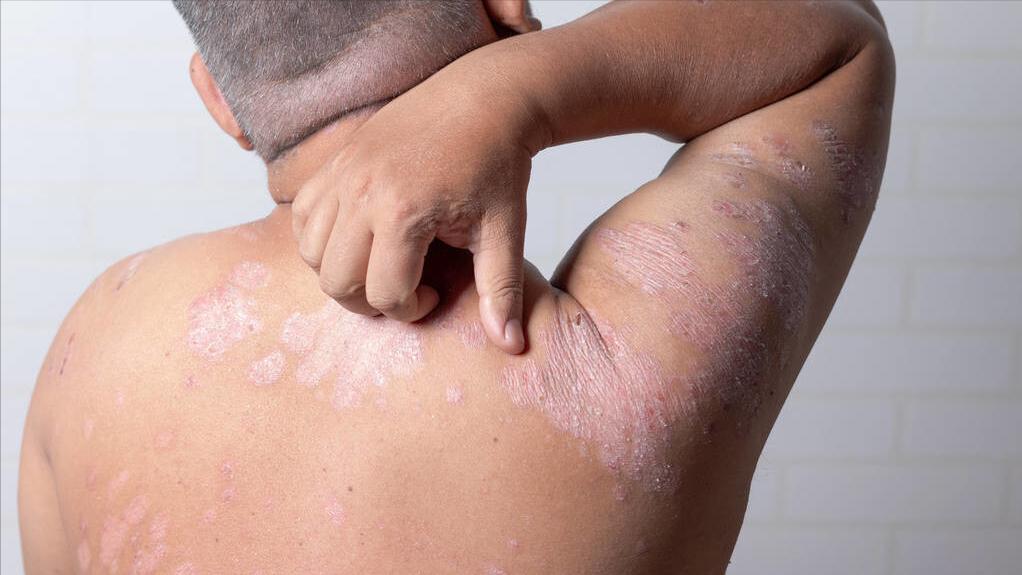 银屑病一直不好怎么办,银屑病中医治疗为啥反反复复