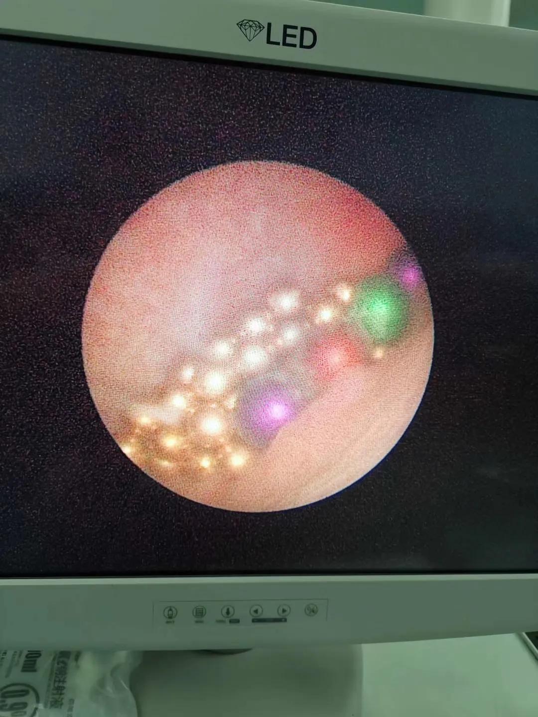 四岁孩子耳朵里塞进钢珠,小男孩往泥巴里塞6个钢珠