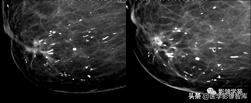 乳腺钙化怎么区分良性和恶性,乳腺钙化的诊断与分级