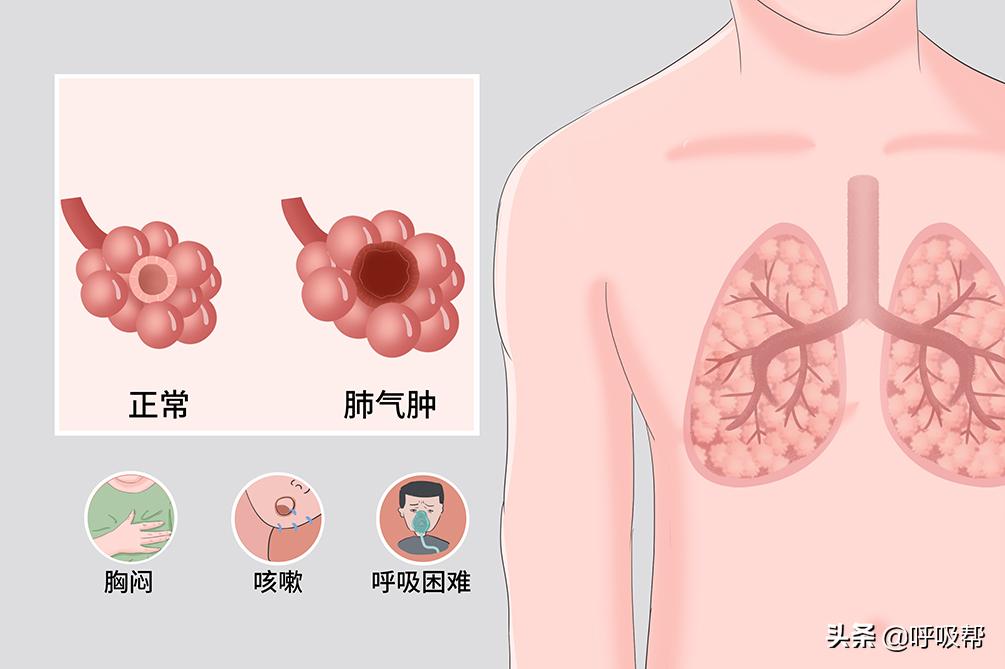 慢性阻塞性肺气肿患者家庭氧疗,慢阻肺家庭氧疗能恢复肺功能吗