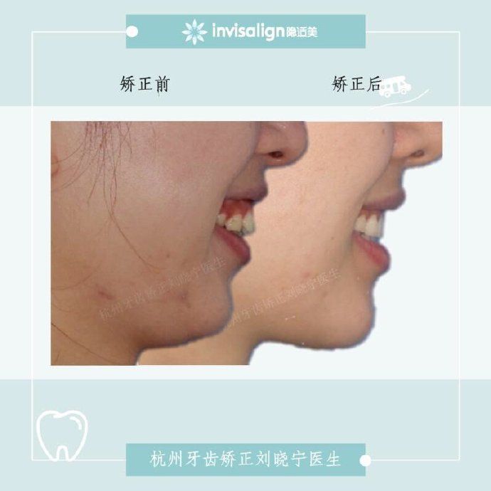 矫正牙齿如何改善露龈笑,矫正牙齿可以改善露龈笑吗