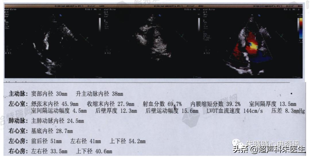 t波倒置诊断,t波倒置如何区分严重程度