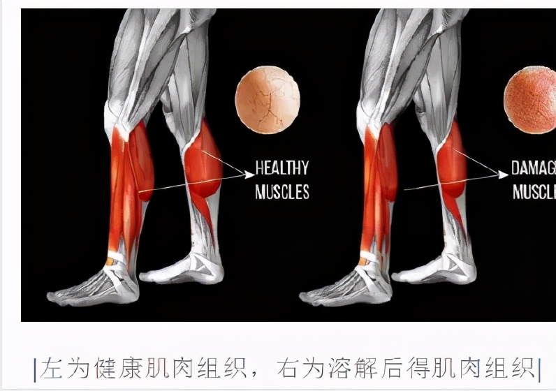 跑步猝死急救方法,跑步昏迷72小时苏醒有后遗症吗