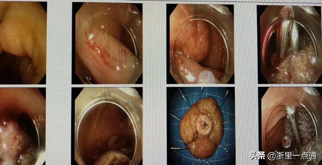 女童便血怎么回事,7岁小女孩便血怎么回事