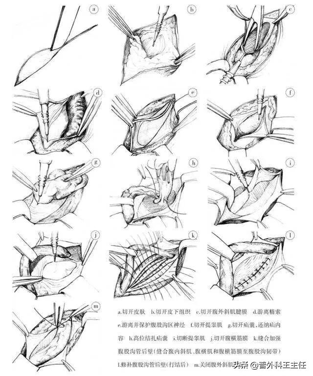 疝气注射疗法是治病还是致病？