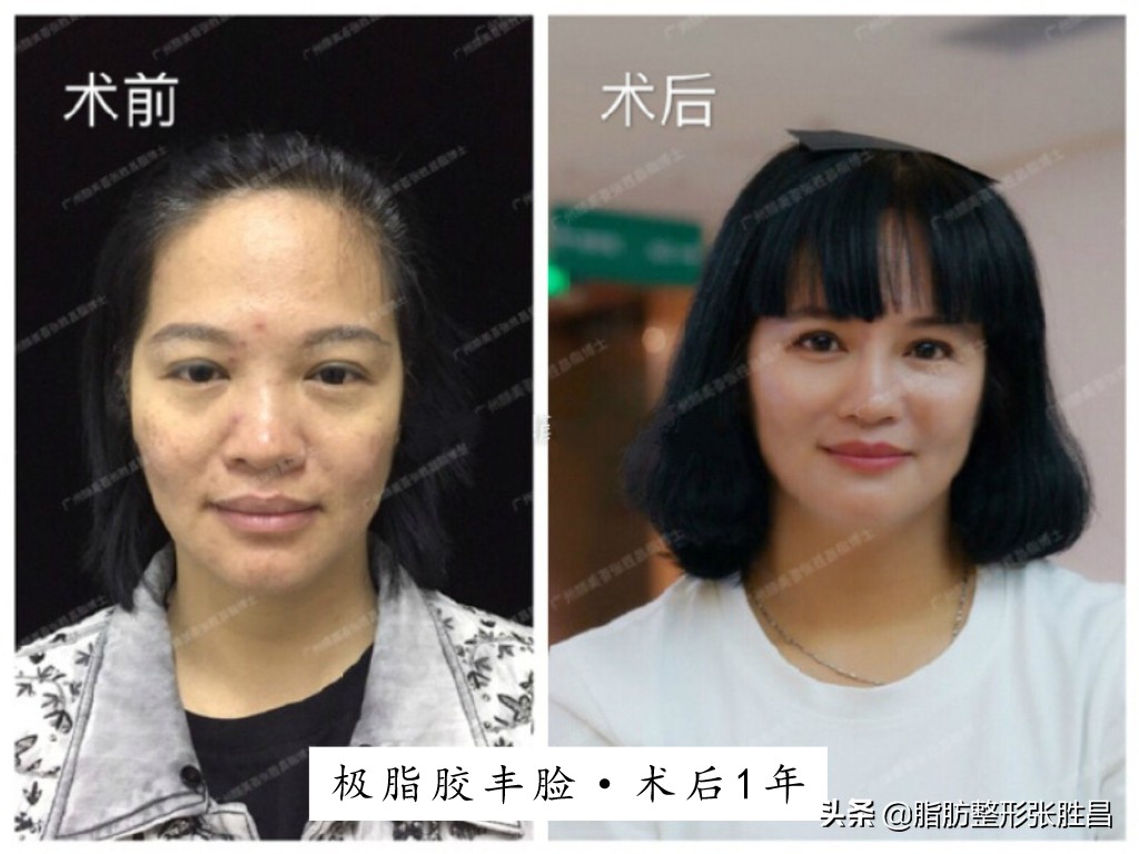 自体脂肪面部填充效果能保持多久,用自体脂肪面部填充怎样才算成功