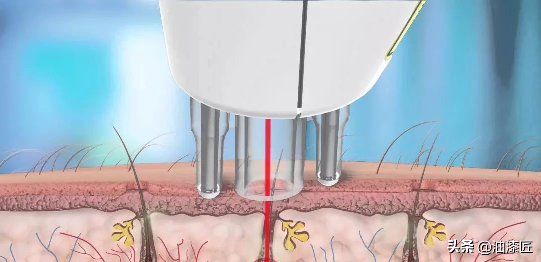 夏季脱毛的旺季来了,夏季来临脱毛