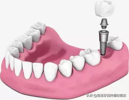 老人也可能种植牙齿吗,老年人骨质疏松能种牙吗