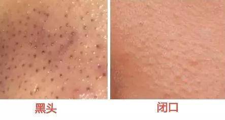 去黑头粉刺最好的建议,真正有效祛黑头粉刺