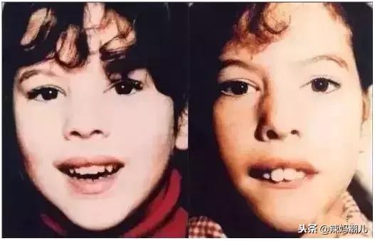 凸嘴的坏习惯,龅牙导致的嘴凸应该怎么改善