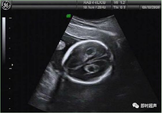 产科常规彩色超声报告单介绍,常见妇科疾病超声报告