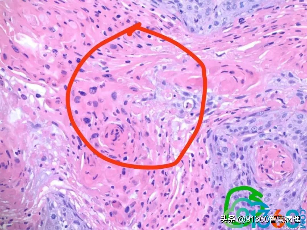 宫颈病理检查与tct检查的区别,病理诊断宫颈活检鳞癌