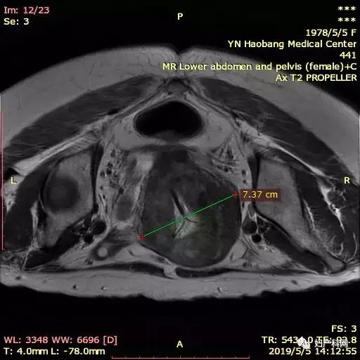 无症状子宫腺肌症可以不治疗吗,微无创超声介入