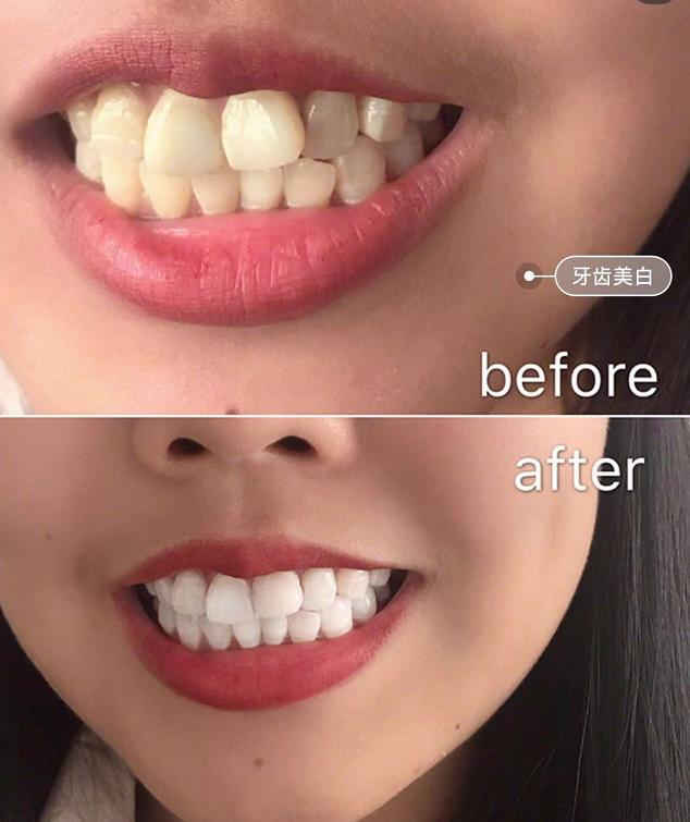 日本“黑科技”美牙产品：每天只需20秒，再也不用三天两头跑医院