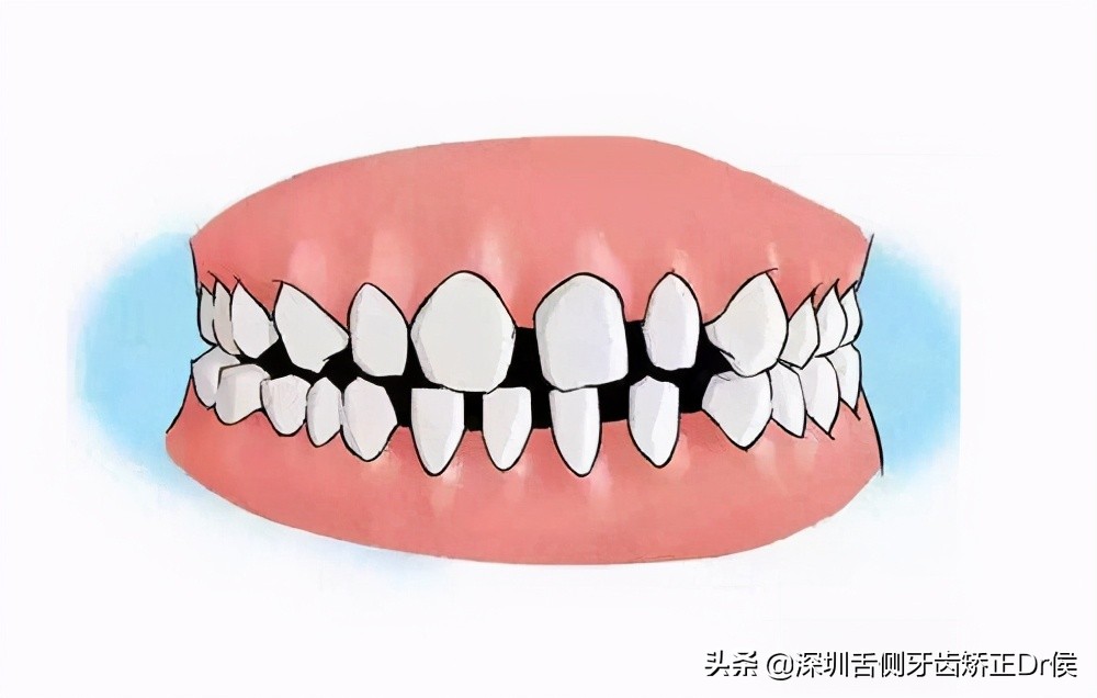 牙齿间缝隙大怎么办,牙齿有缝隙需要修复吗