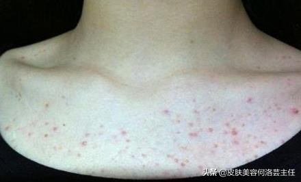 痘痘反反复复，脸上坑坑洼洼，到底是什么原因？