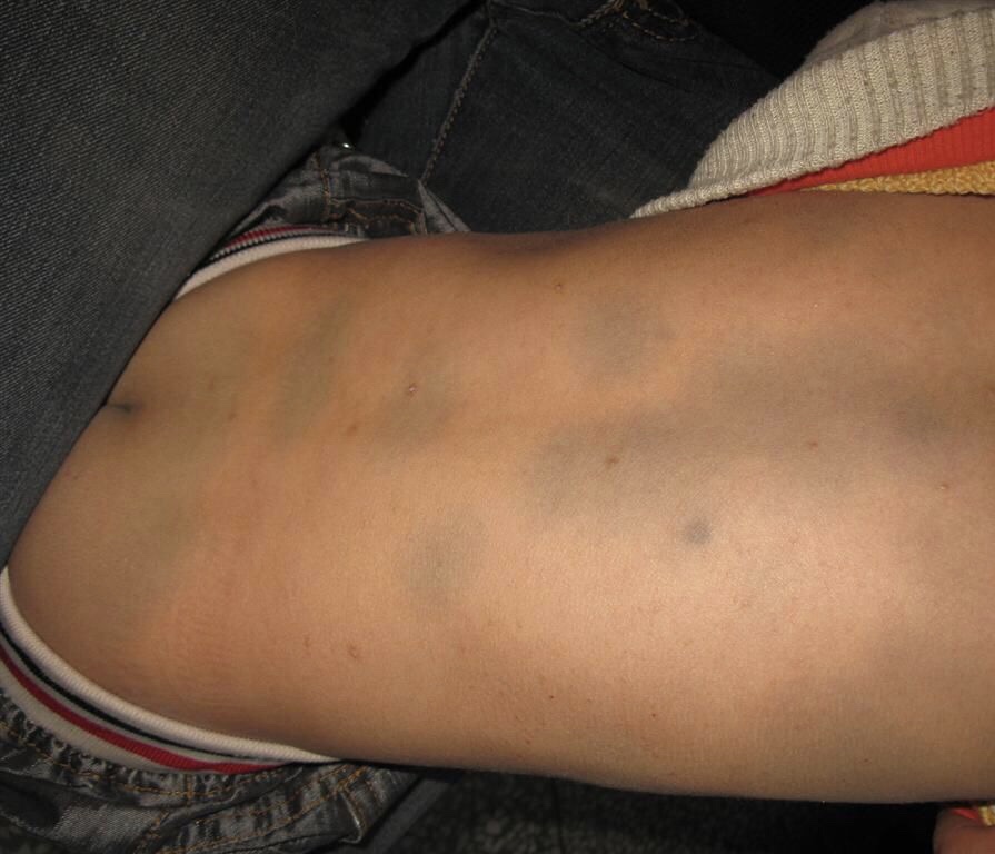 宝宝一出生就有雀斑样痣吗,出生的婴儿皮肤有黑斑怎么回事