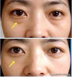 不要做眼袋手术的原因,千万不要去美容医院割眼袋