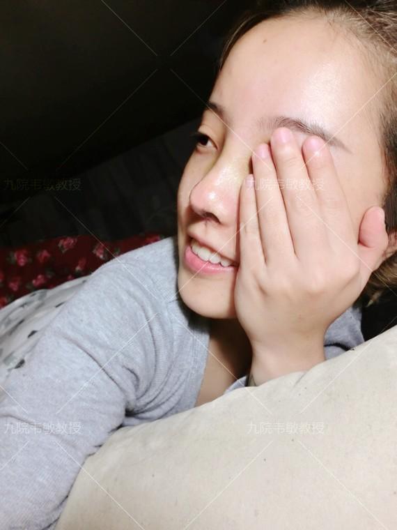 假体隆鼻科普之膨体隆鼻,膨体隆鼻整形效果怎么样