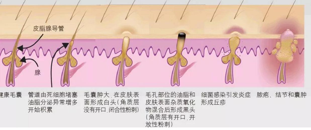 额头闭口反反复复怎么办,额头反反复复长闭口粉刺怎么办