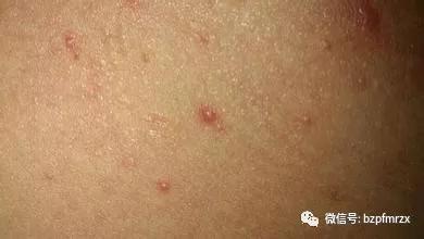 皮肤科医学博士告诉你皮肤病到底会不会传染?