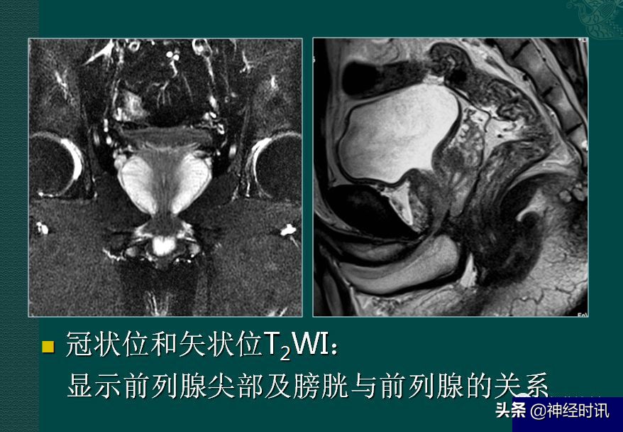 肾脏输尿管膀胱前列腺结构,肾输尿管膀胱解剖示意图