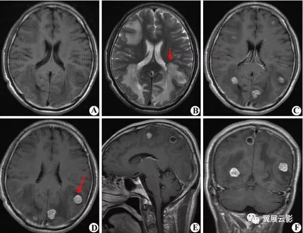 脑部脓肿怎么治疗,多发性脑脓肿能自愈吗