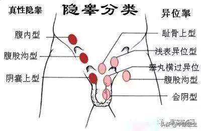 7岁男孩从出生就摸不到*丸睾**听信7岁才手术，专家：晚了，终身不育