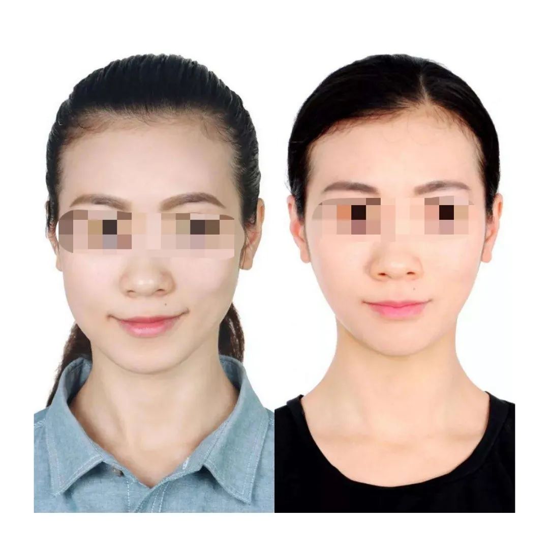 如何改善下颌大小脸,有效纠正脸歪的方法