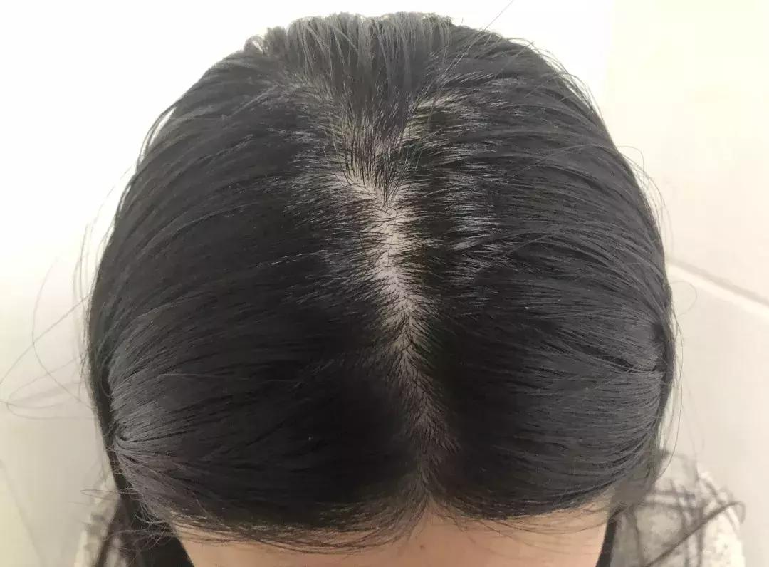 头发毛躁并且脱发推荐洗发水,用什么洗发水改善头皮脱发