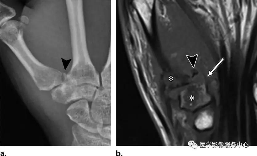 手腕撕脱性骨折一年了还隐隐作痛,手腕三角骨撕脱骨折症状有哪些