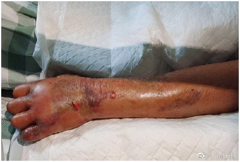 食肉菌是什么样的细菌,食人菌有多可怕