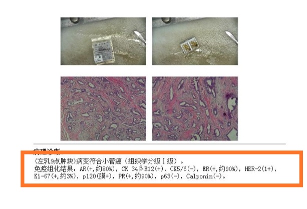 预后最好的乳腺癌病理类型,乳腺癌病理分型预后最差