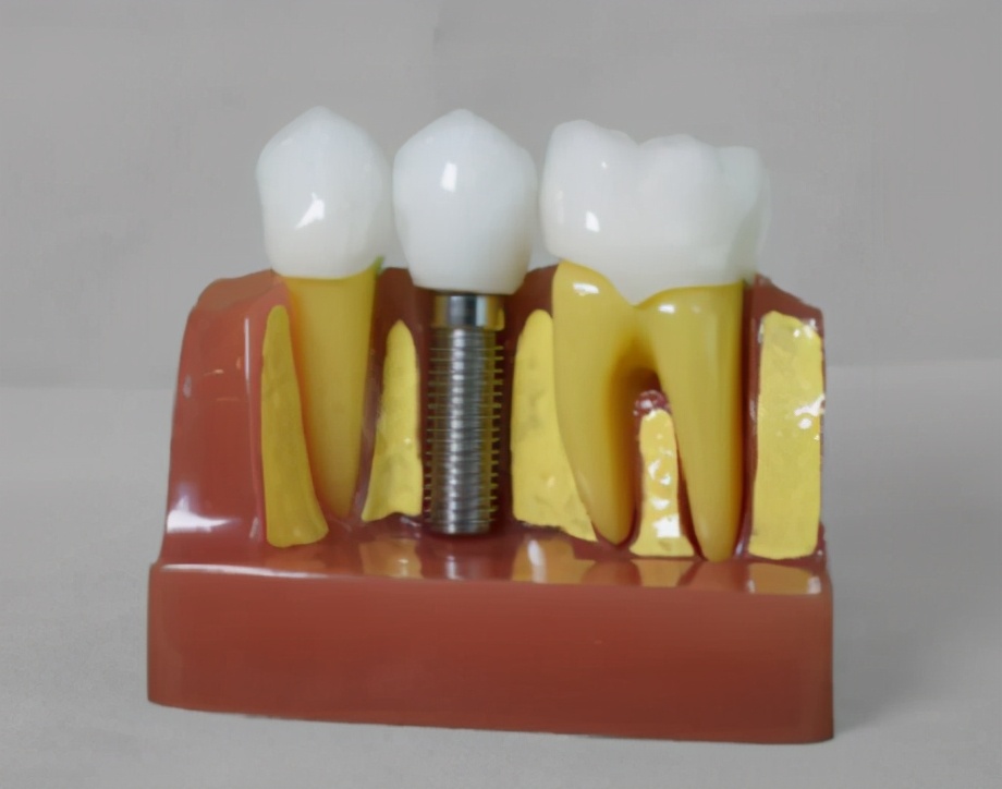 种牙内幕,种植牙的猫腻在什么地方