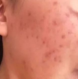 痘痘不可怕泛红才可怕,痘痘不是非常严重要不要管
