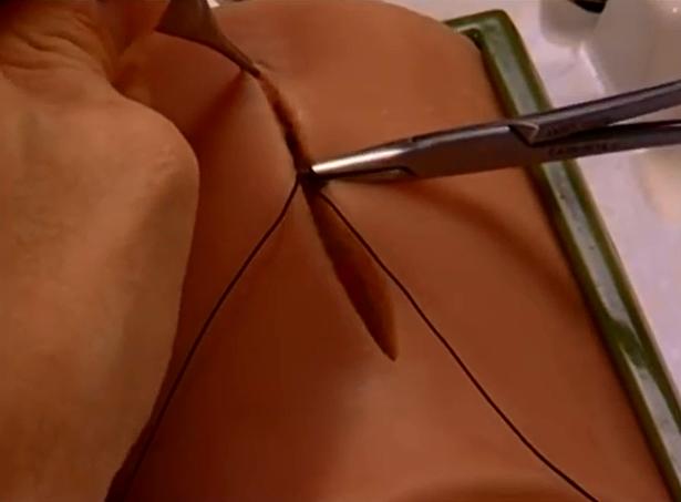 疤痕体质孕妇要注意什么,疤痕体质孕妇剖腹产后疤痕什么样