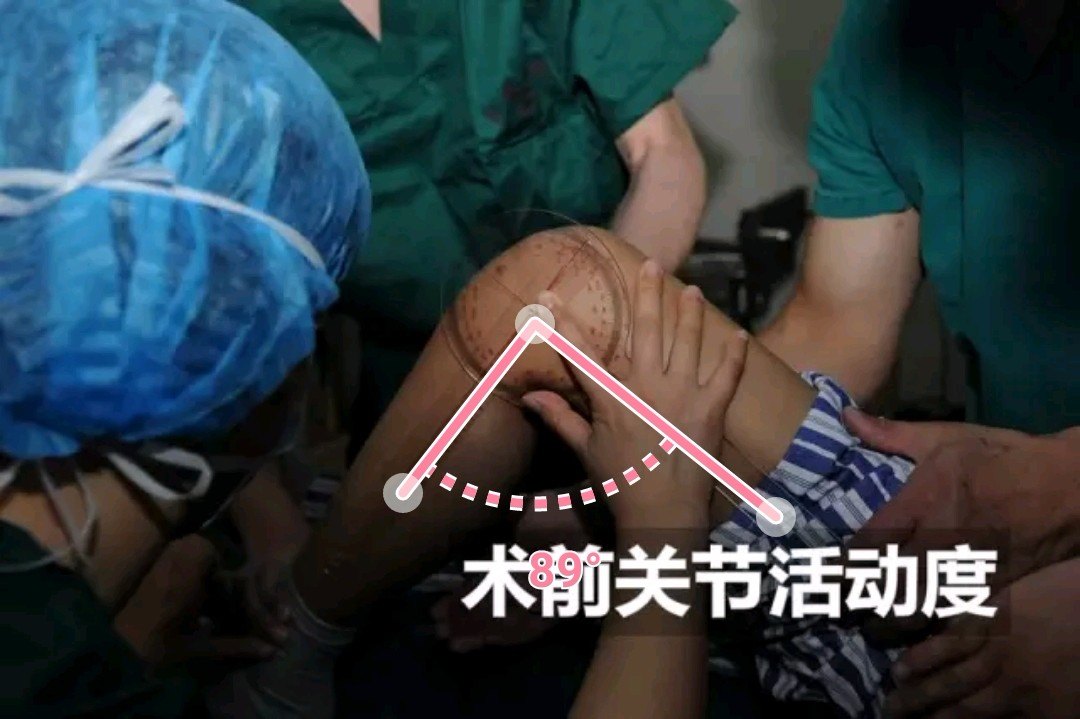 膝盖做了手术如何康复训练按摩,膝盖术后弯曲不了做按摩有用吗